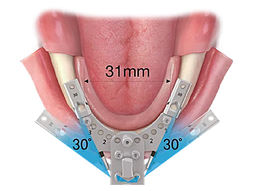 Denture 4U Kit