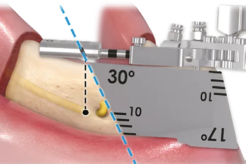 Denture 4U Kit