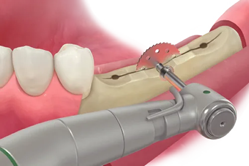 ESSET Kit
