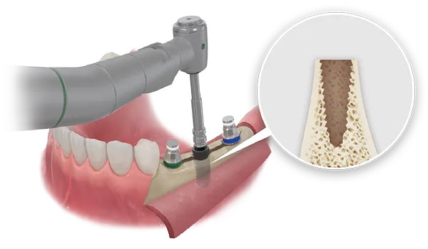 ESSET Kit