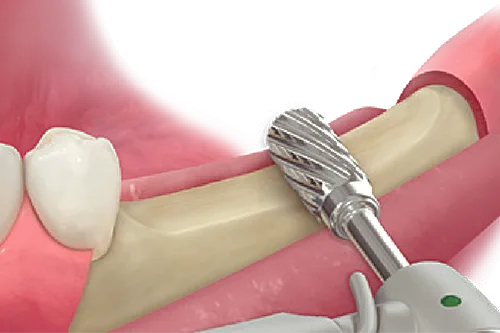 ESSET Kit
