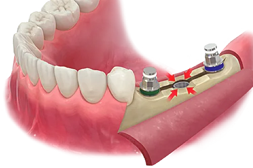ESSET Kit