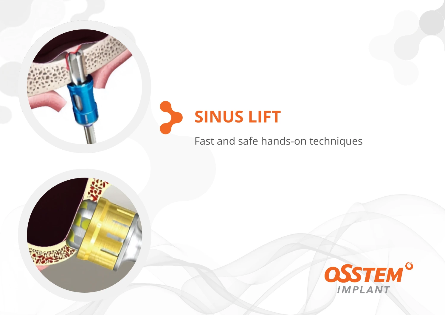 Sinus Lifting