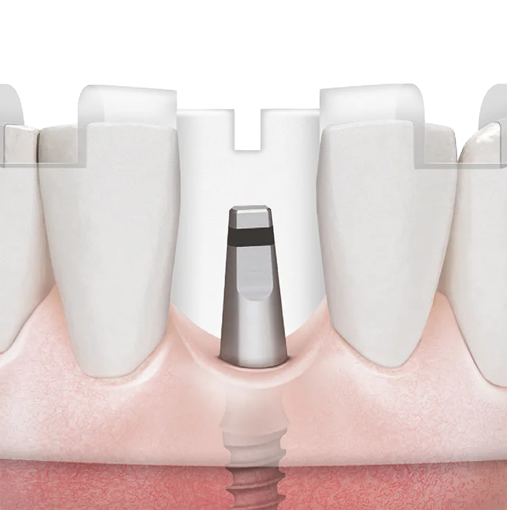 OneMS Kit