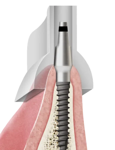OneMS Kit