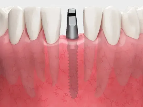 MS Implant