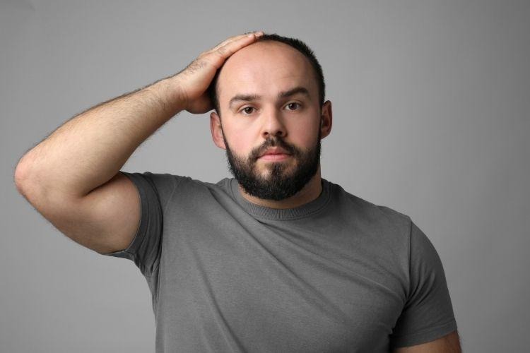 Man with male pattern baldness showing hair thinning linked to DHT and conversion of testosterone. [Photo by Africa images on Canva.]