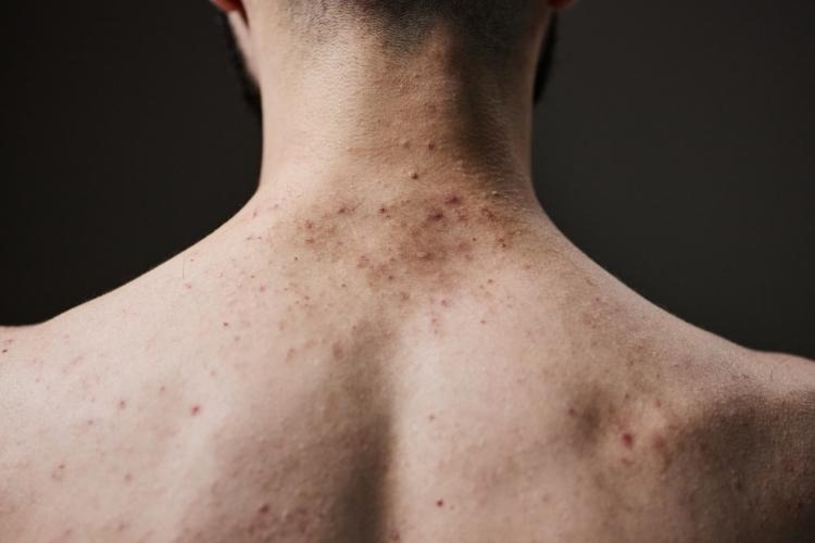 Man's back with moderate acne.