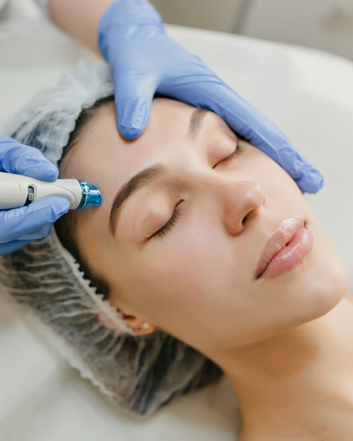 Radiofrequency microneedling handpiece being applied to a patient's face