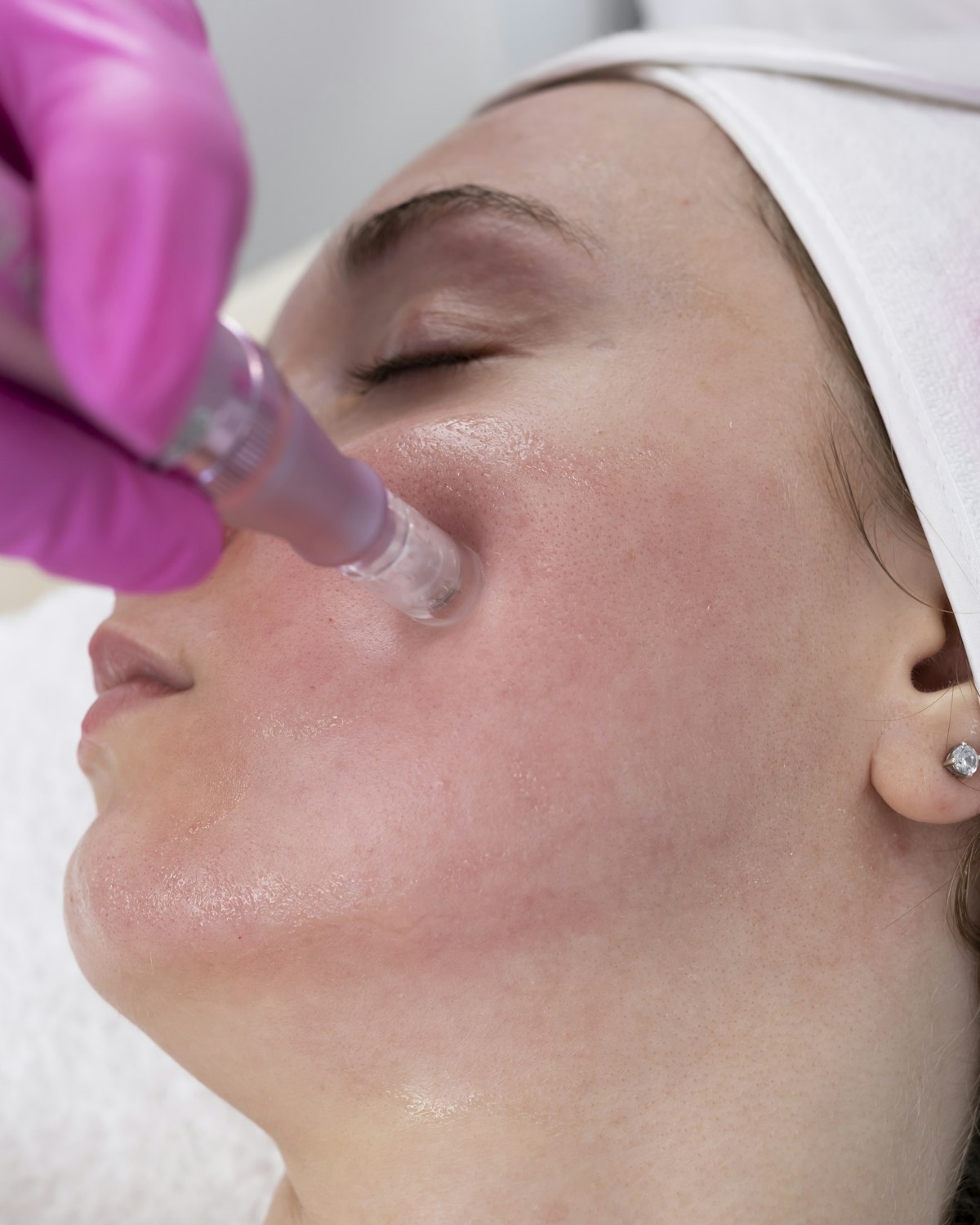 Microneedling pen being applied to a patient's cheek
