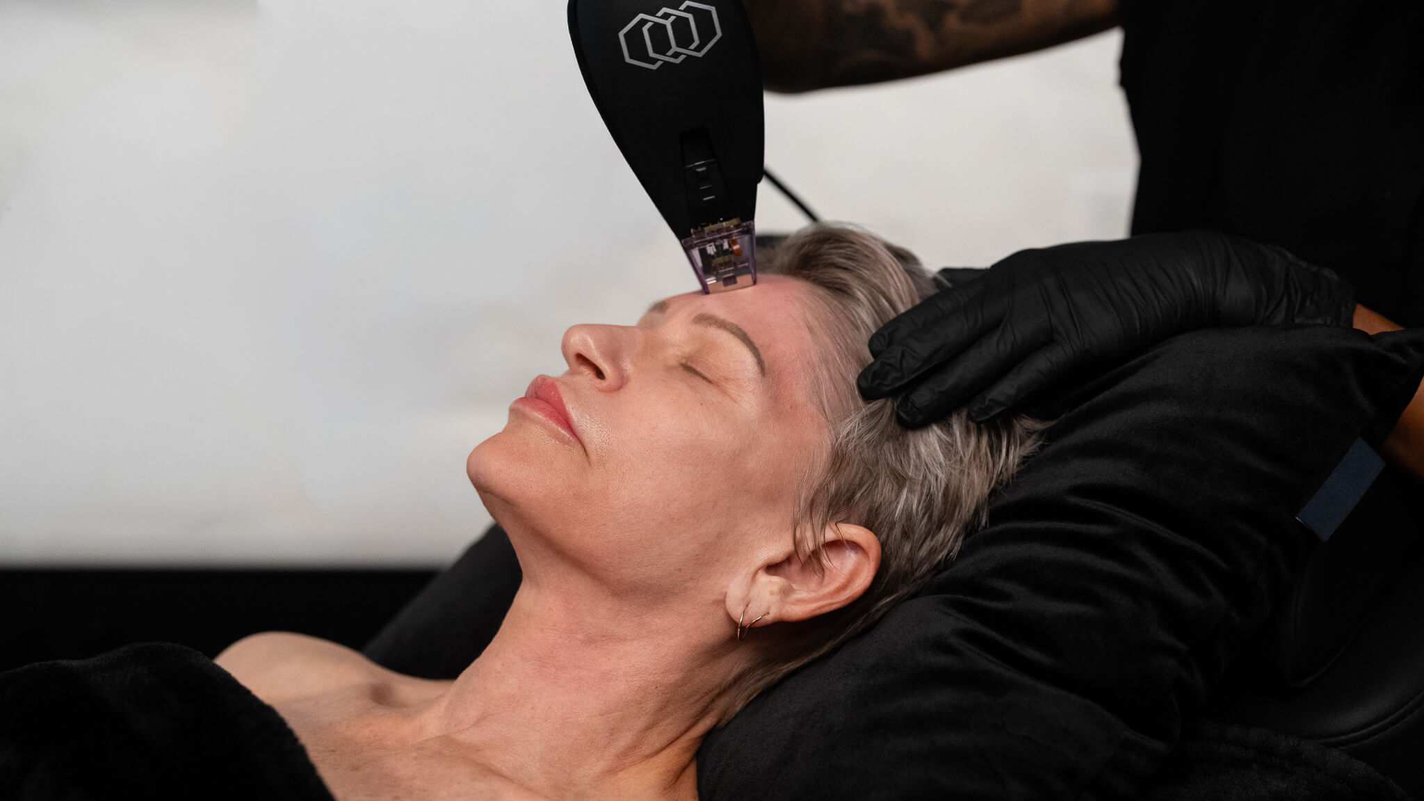 Morpheus8 2.0 RF Microneedling