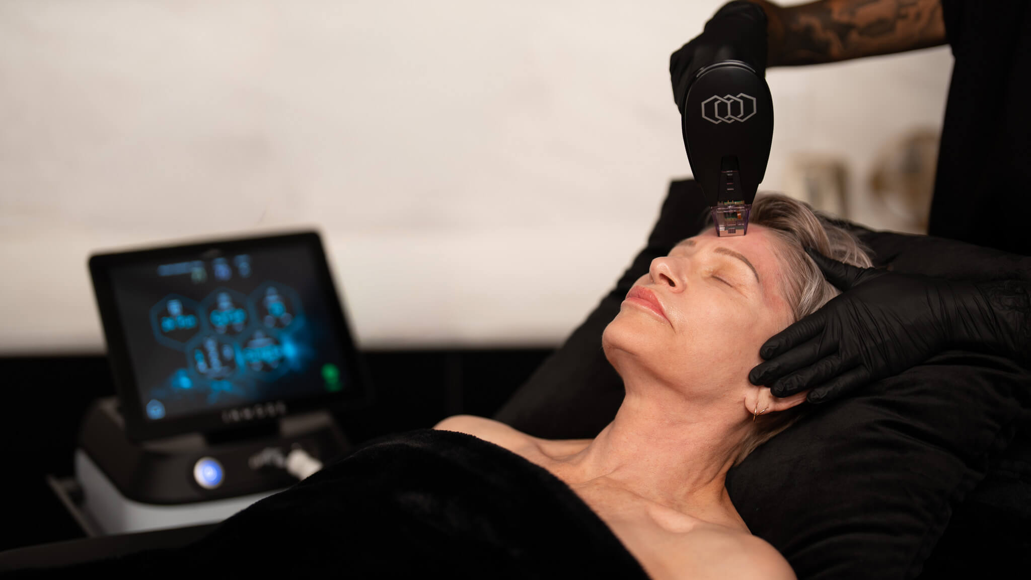 Post-Treatment Care for Morpheus8: Essential Tips for Optimal Results