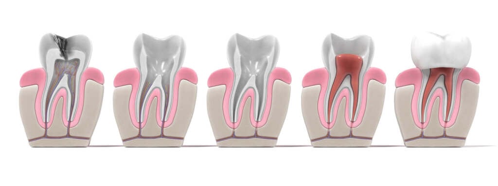 Paso a Paso de una Endodoncia Washington Heights