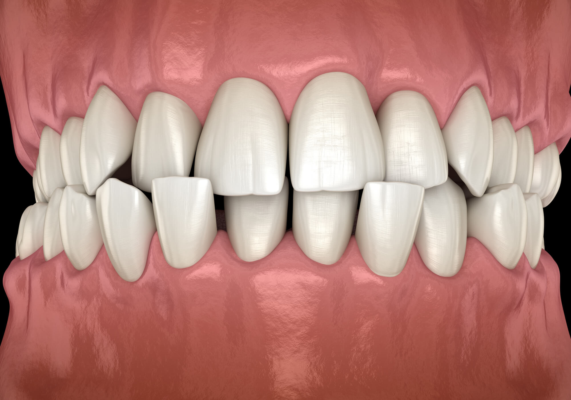 crooked teeth image used by  Orthodontist Fordham Road