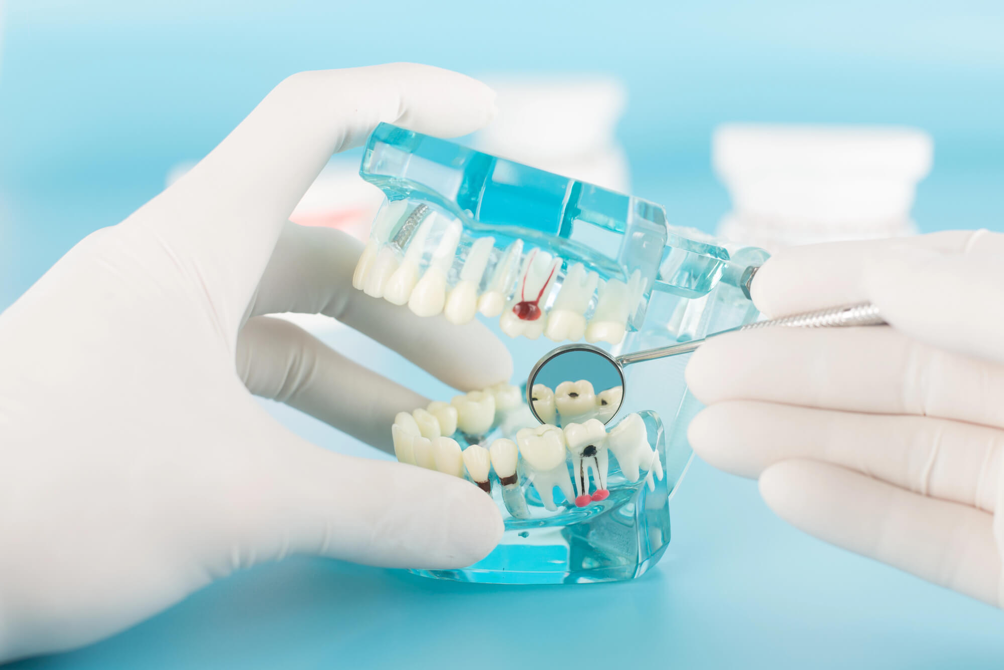 Modelo dental mostrando diente dañado antes de Endodoncia Inwood