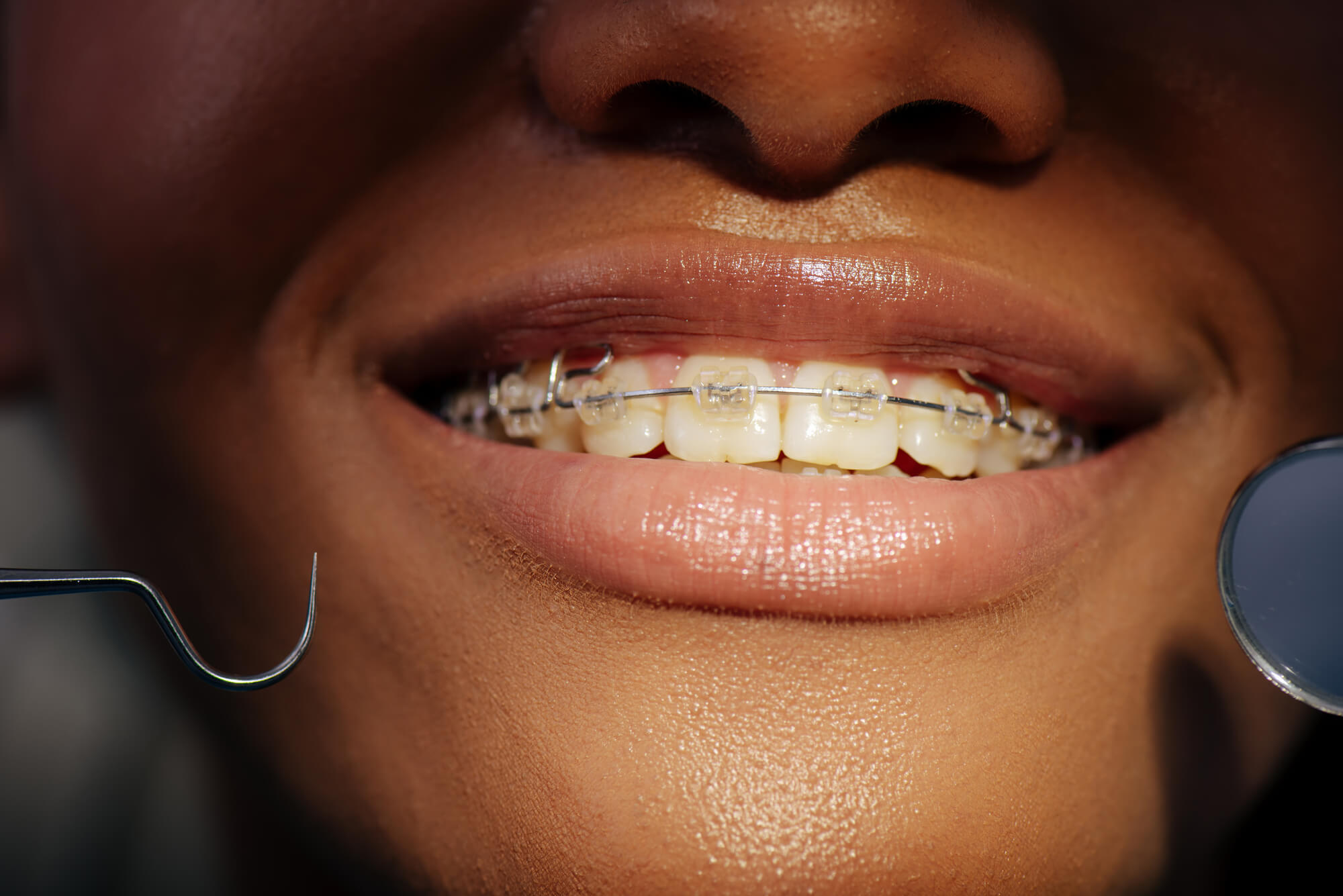 woman with clear braces after going to an orthodontist fordham road