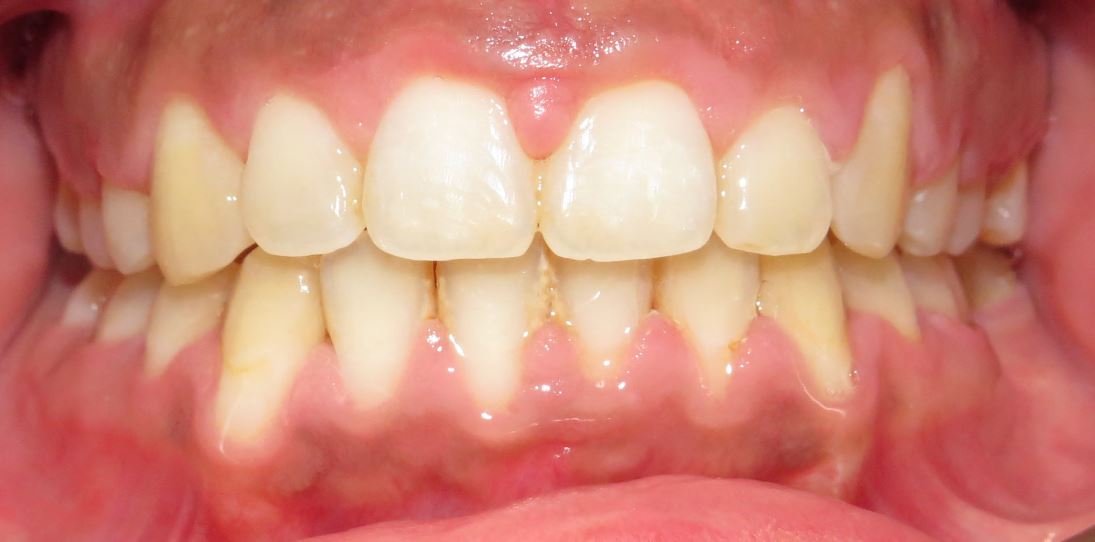 After orthodontic treatment – Case 4