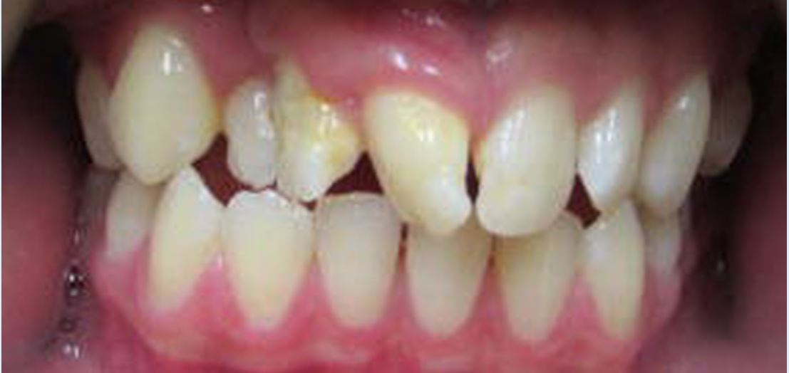 Before orthodontic treatment – Case 1