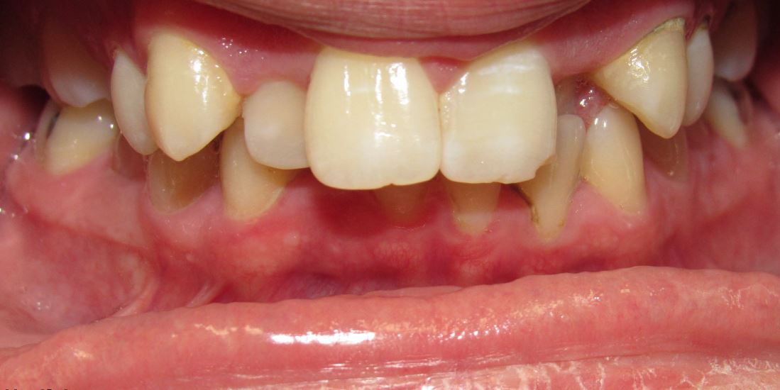Before orthodontic treatment – Case 3