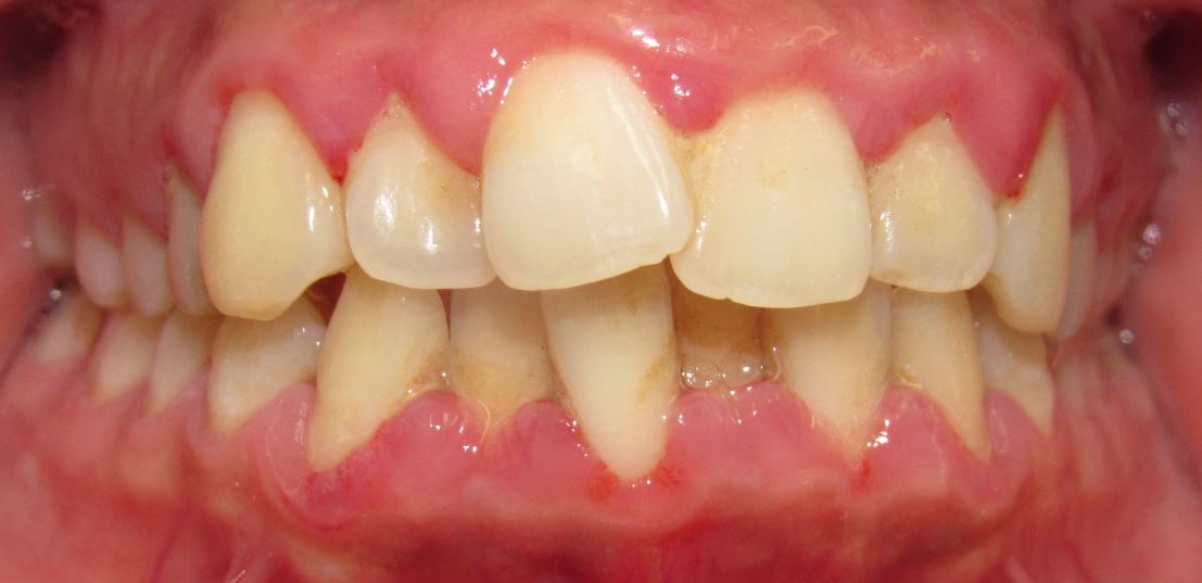 Before orthodontic treatment – Case 4
