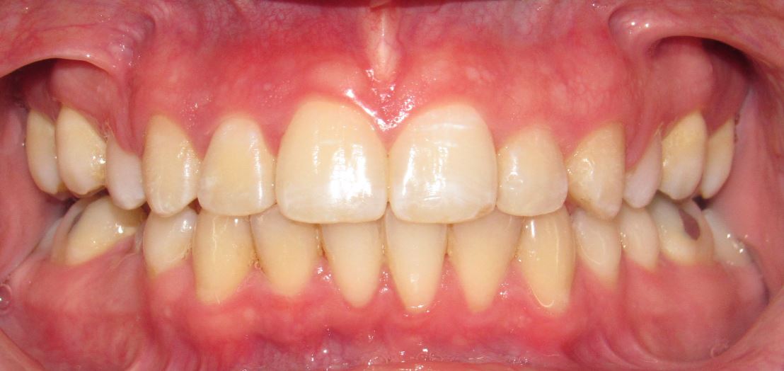 After orthodontic treatment – Case 3
