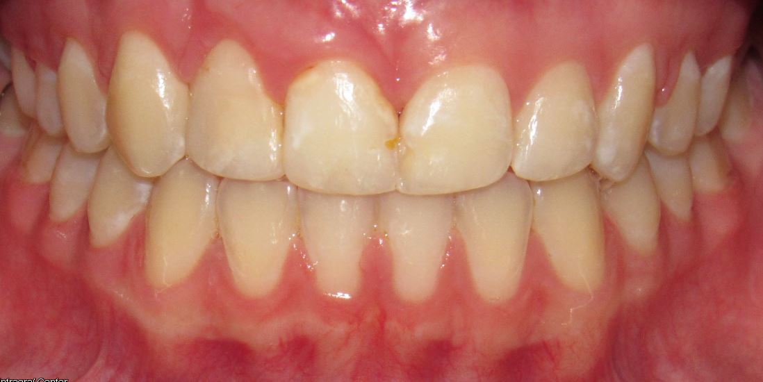 After orthodontic treatment – Case 1