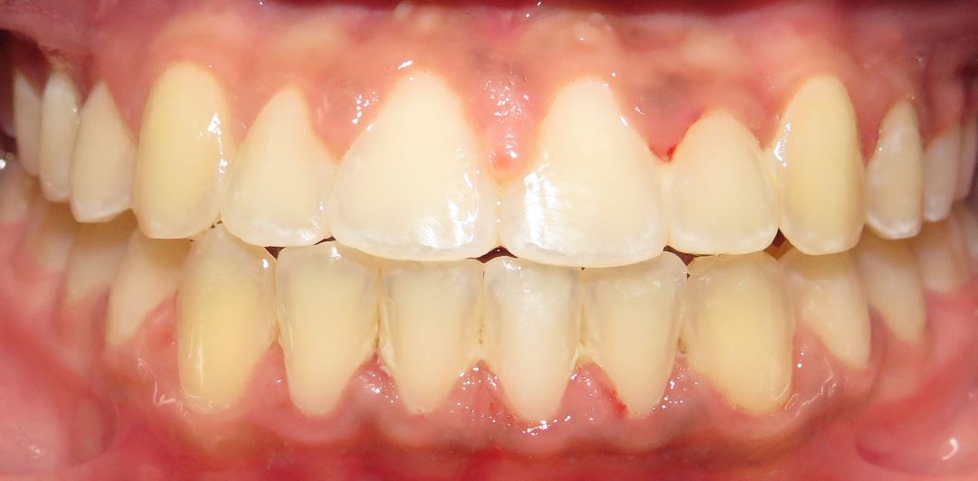After orthodontic treatment – Case 2