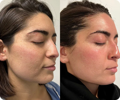 Side-by-side profile photos of a woman's face before and after a skincare treatment showing improved skin texture and reduced redness.