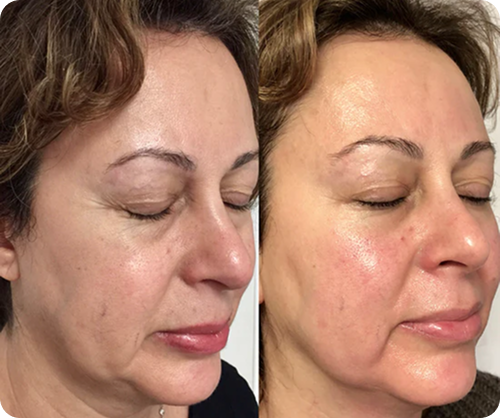 Side-by-side close-up photos of a woman's face before and after a skincare treatment, showing smoother and more radiant skin on the right.