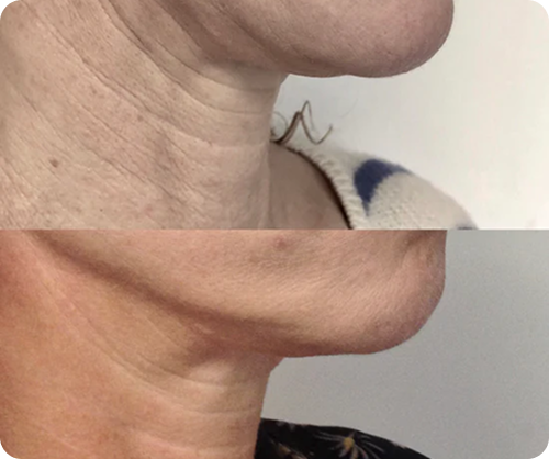 Side-by-side comparison of a person's neck and jawline showing reduced wrinkles and smoother skin in the bottom image.