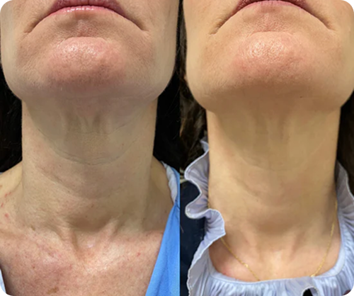 Before and after comparison of a woman's neck showing reduced redness and smoother skin texture in the after image.