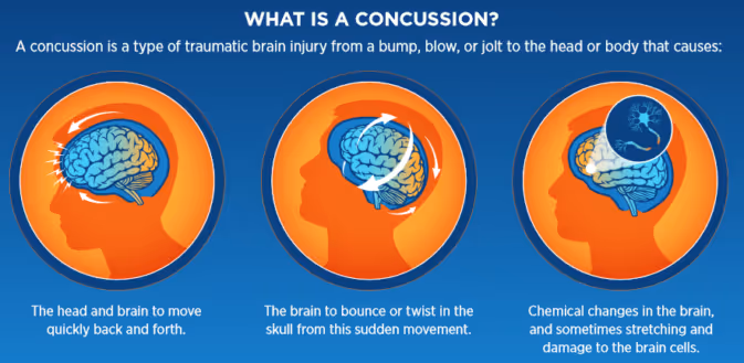What is a concussion