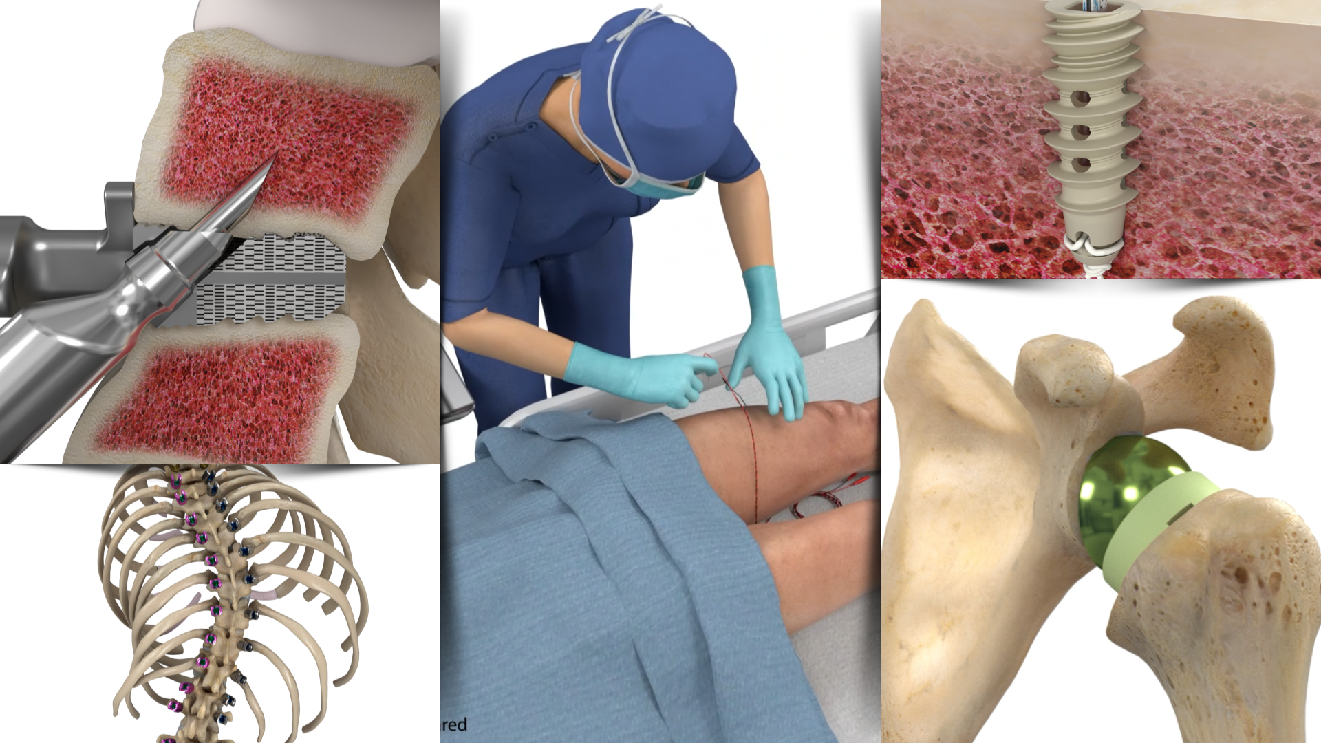 Composite medical illustration showing spinal surgery with a drill on vertebrae, a surgeon stitching a patient's knee, a spinal implant in bone, a ribcage with spinal fixation, and a hip joint replacement.