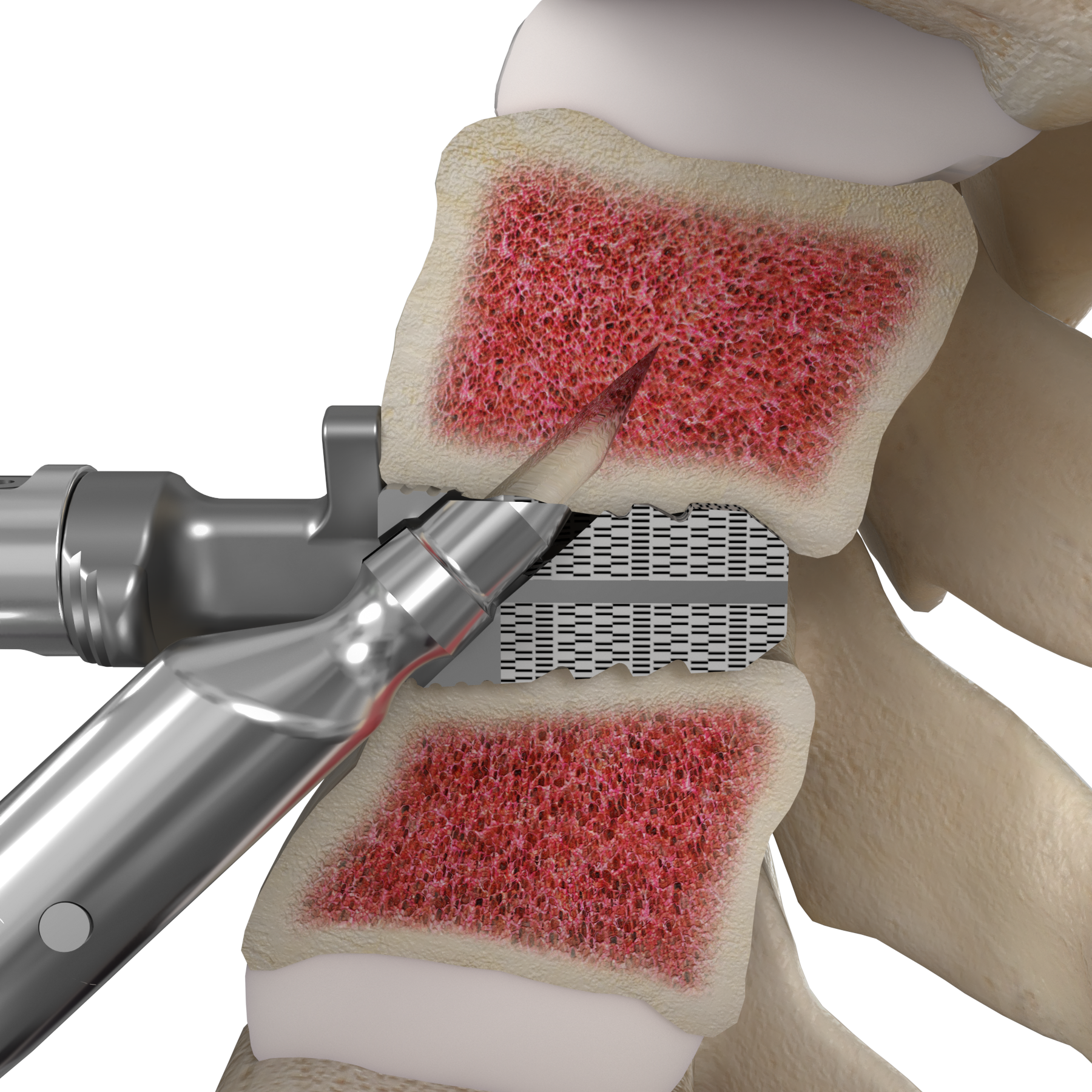 Medical device fixes spinal disk
