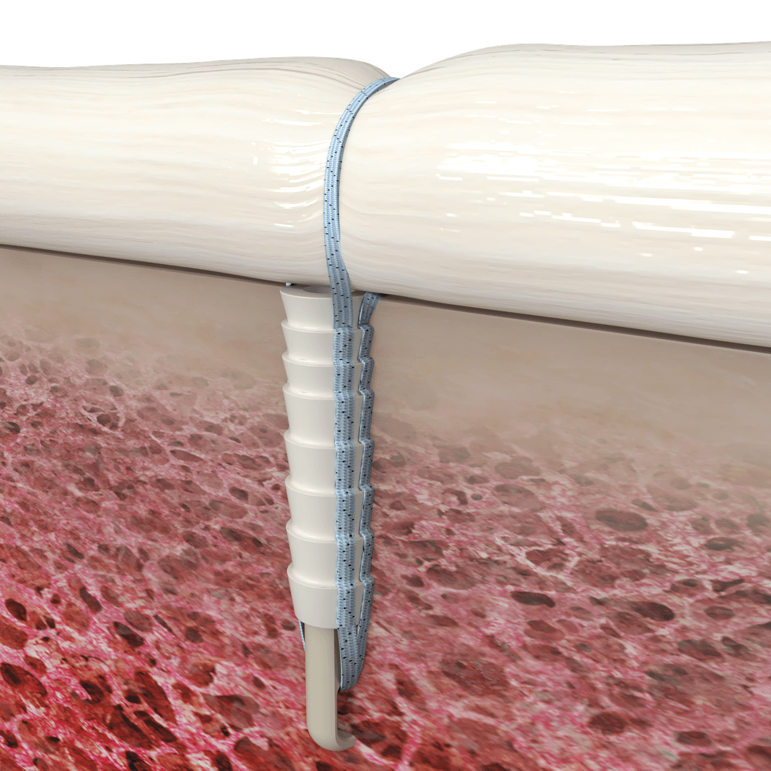 Suture anchor cross-section render in hard bone with biocomposite