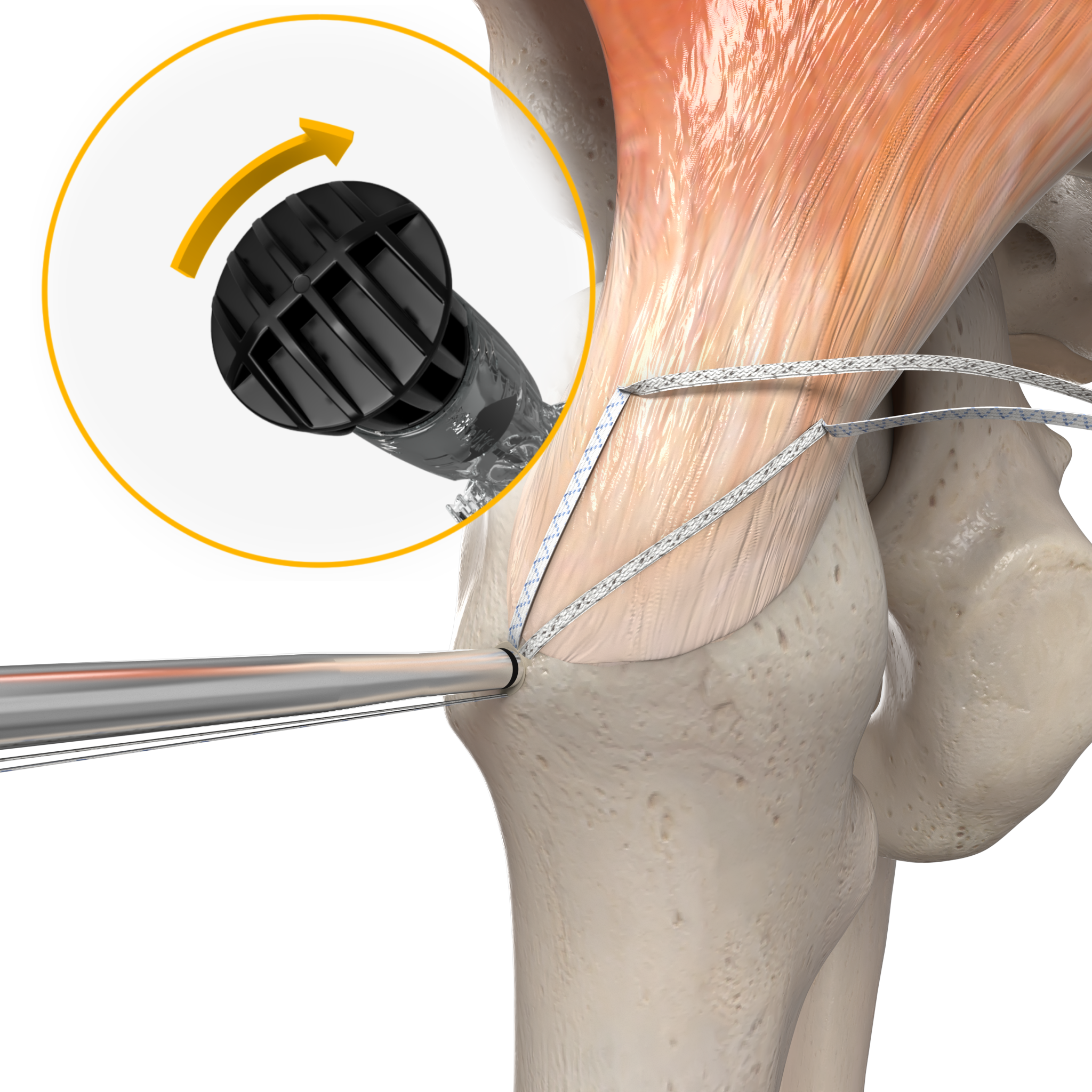 3D medical image showing a cross-section of human hip anatomy with a catheter wire inserted, next to a close-up inset of a black medical port device with a yellow arrow indicating a locking mechanism.