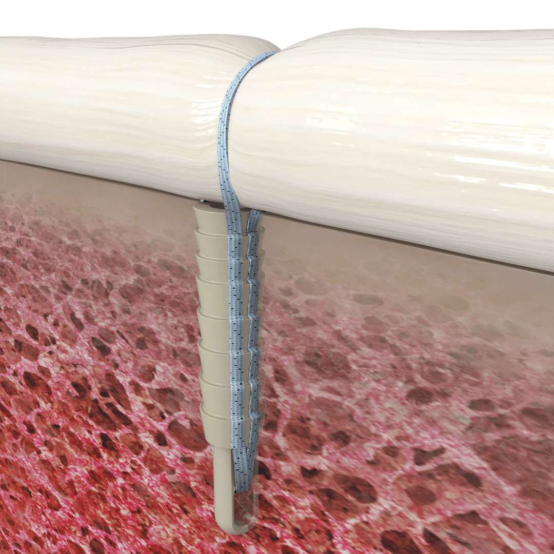 Suture anchor cross-section render in soft bone