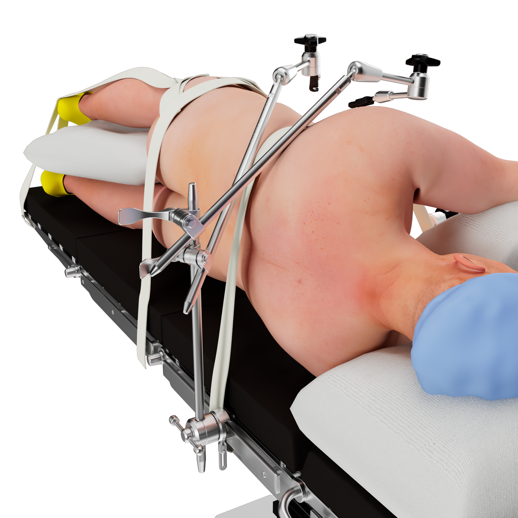 A 3D image of a patient undergoing spinal surgery. Hilighting the medical device used to preform the surgery.