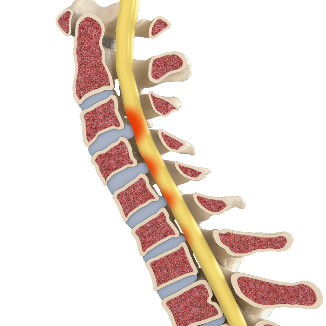 Cervical spine pathology: myelopathy