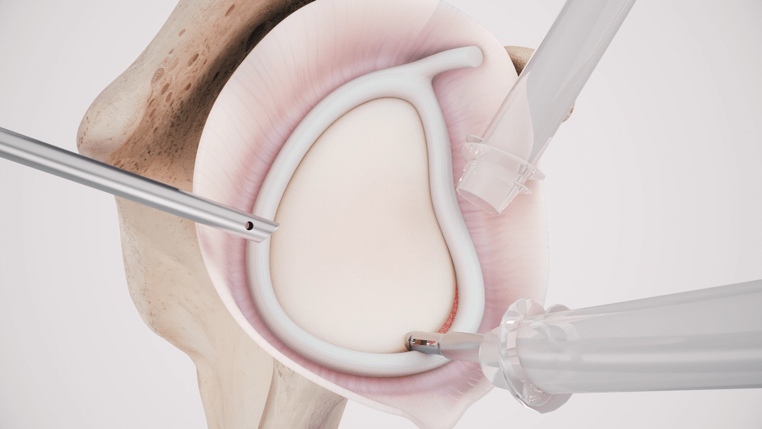 Shoulder labral repair render with the instrument in place