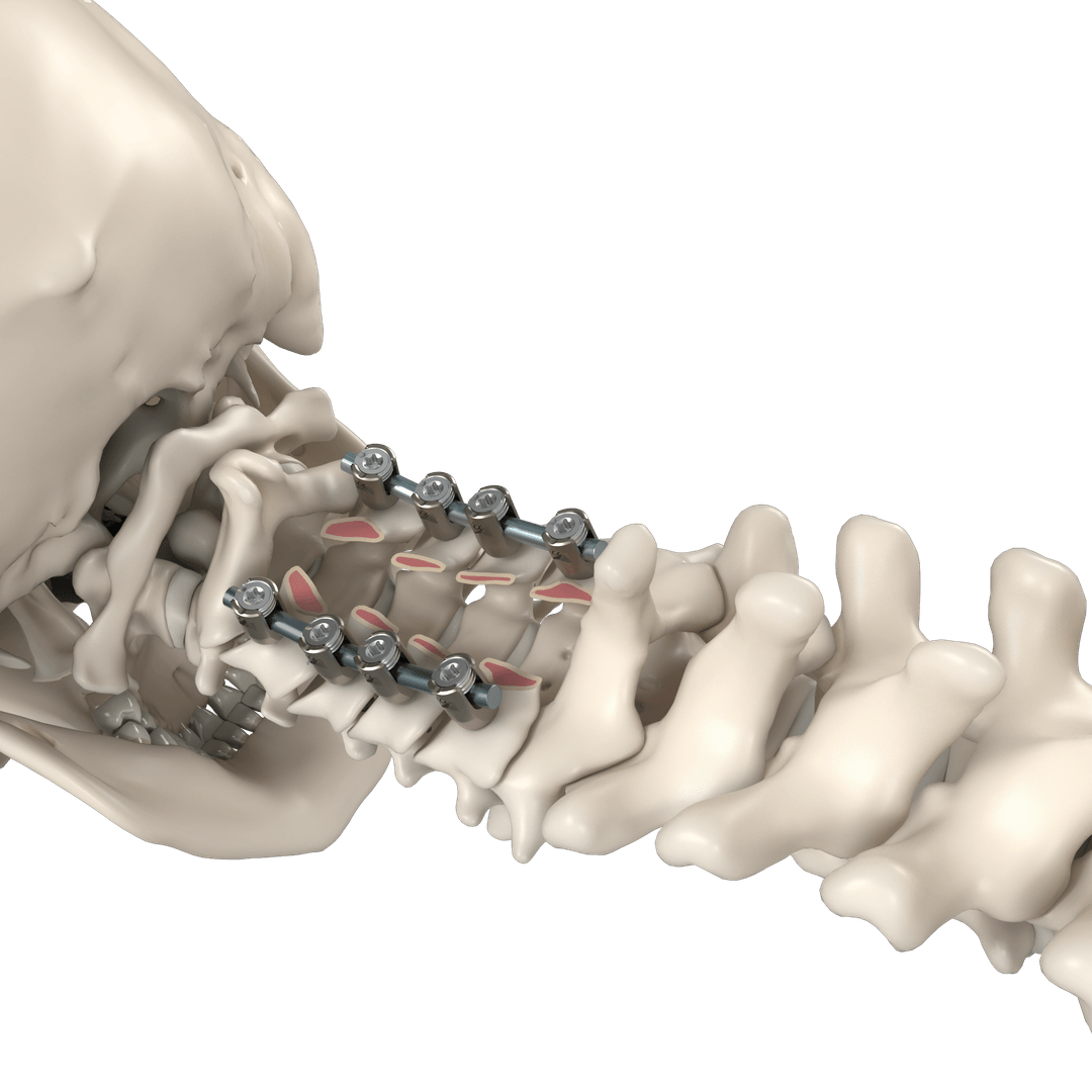 Cervical construct with laminectomy