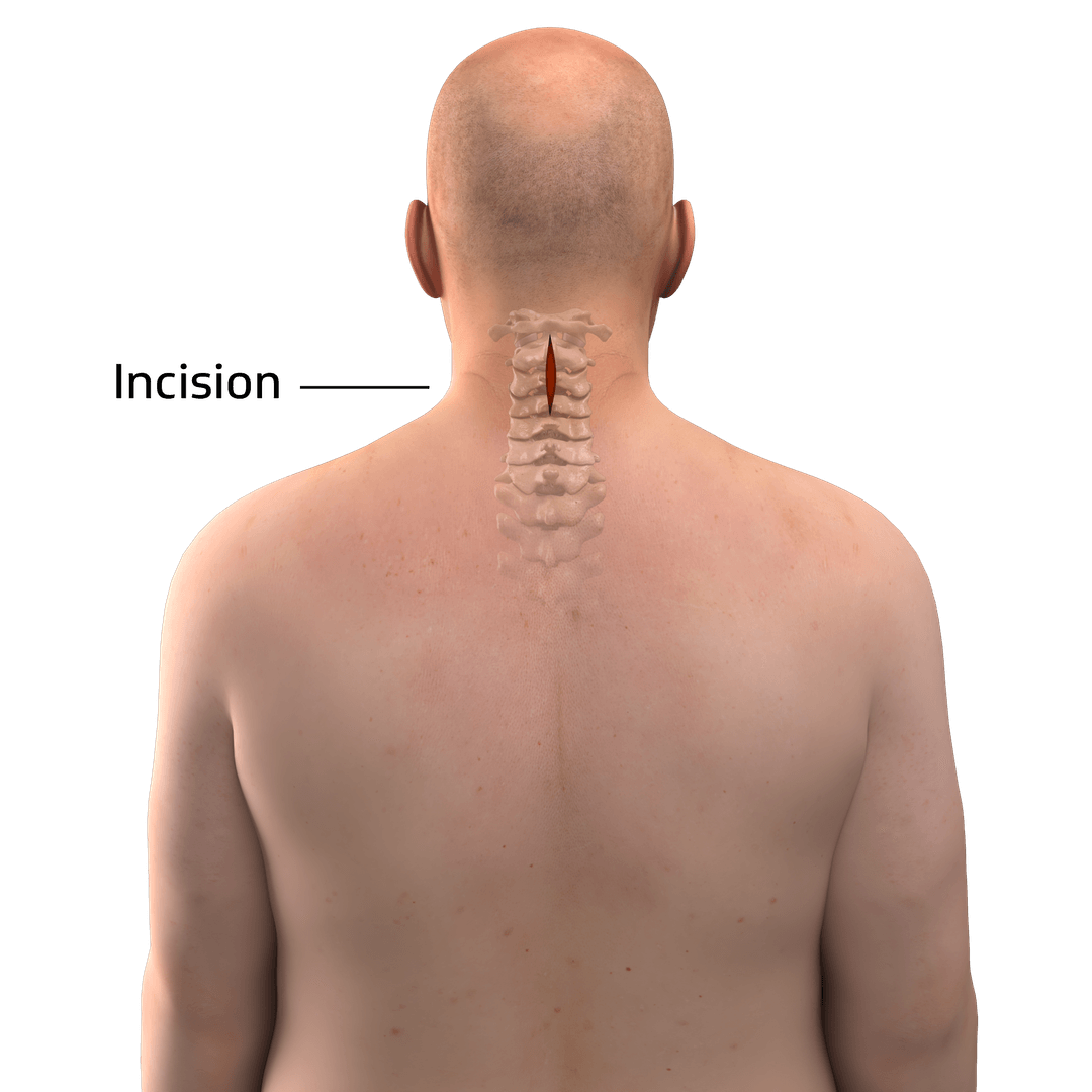 Patient positioning and cervical incision