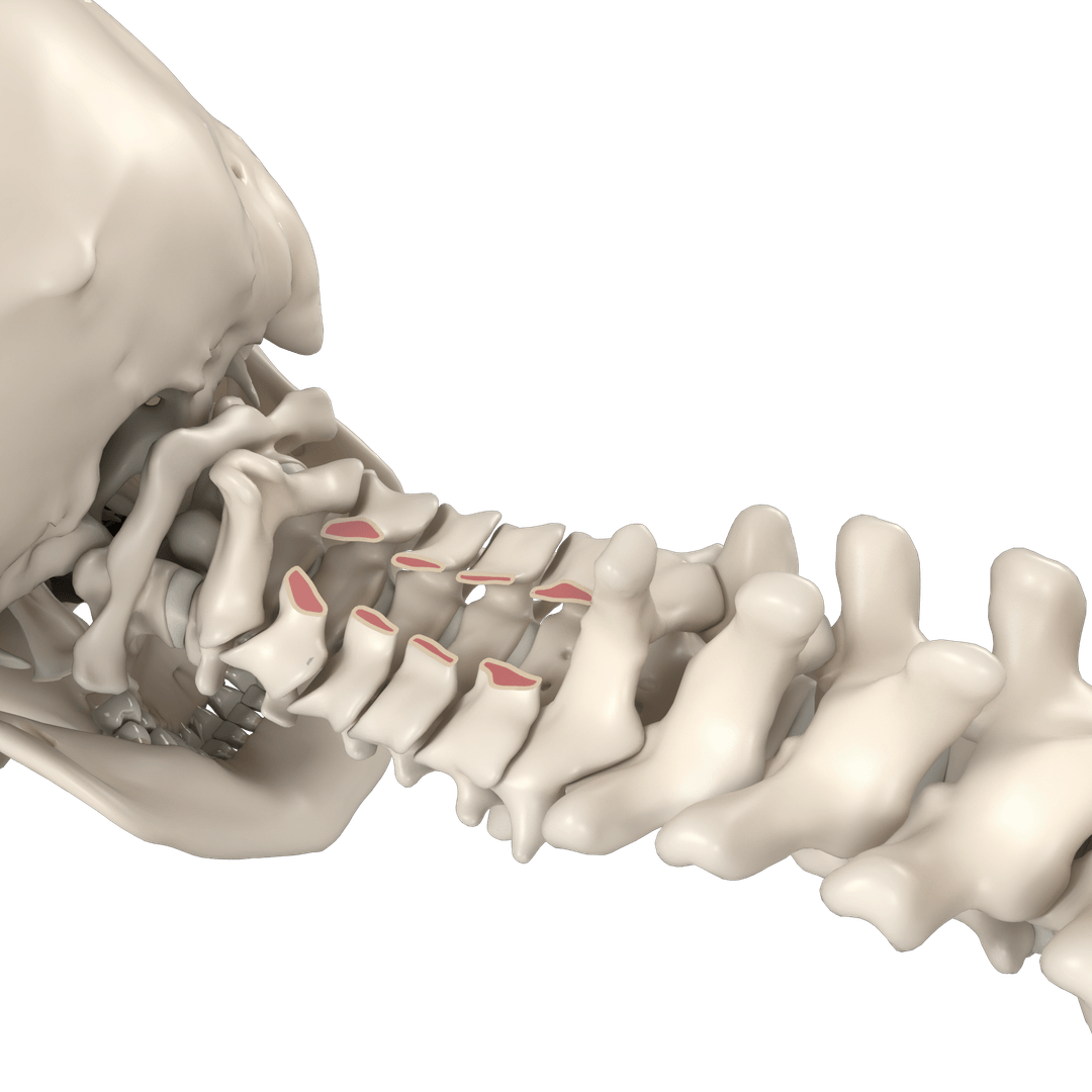 Laminectomy