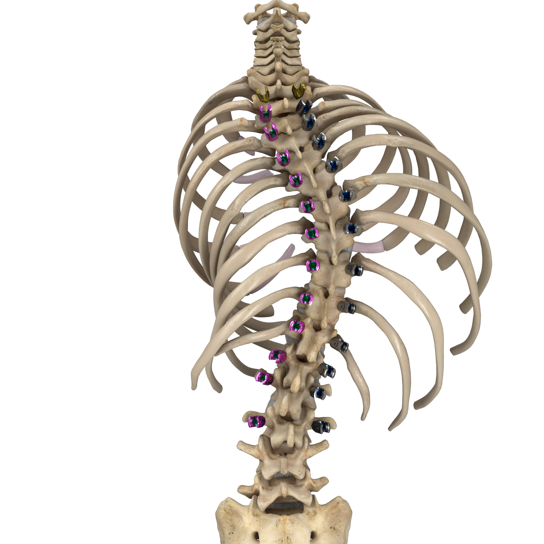 3D medical image of scoliosis correction procedure.