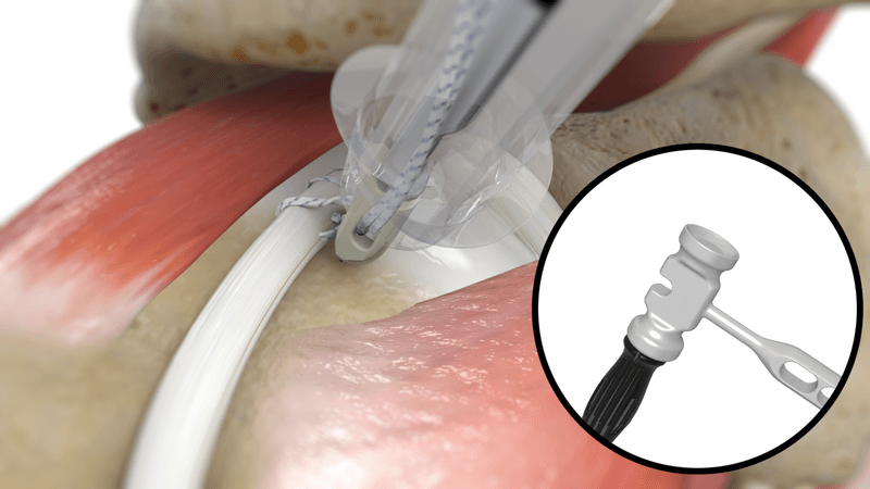 Surgical Procedure