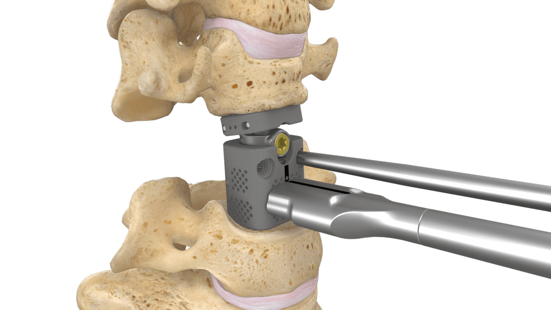 Interbody cage on its inserter, from a surgical technique guide