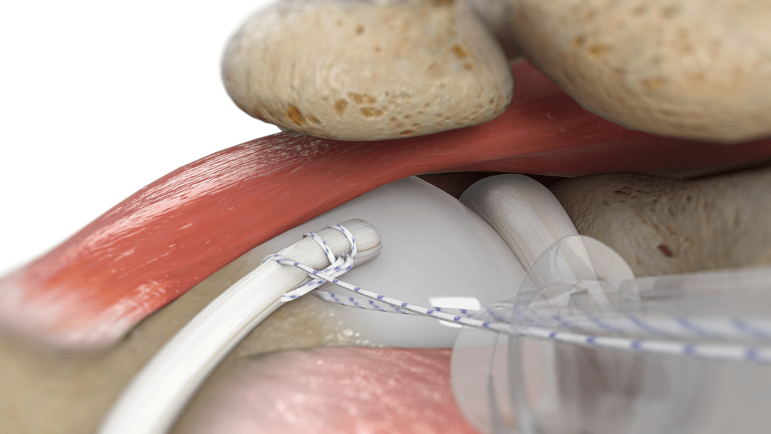 Fixation step from a step-by-step surgical animation