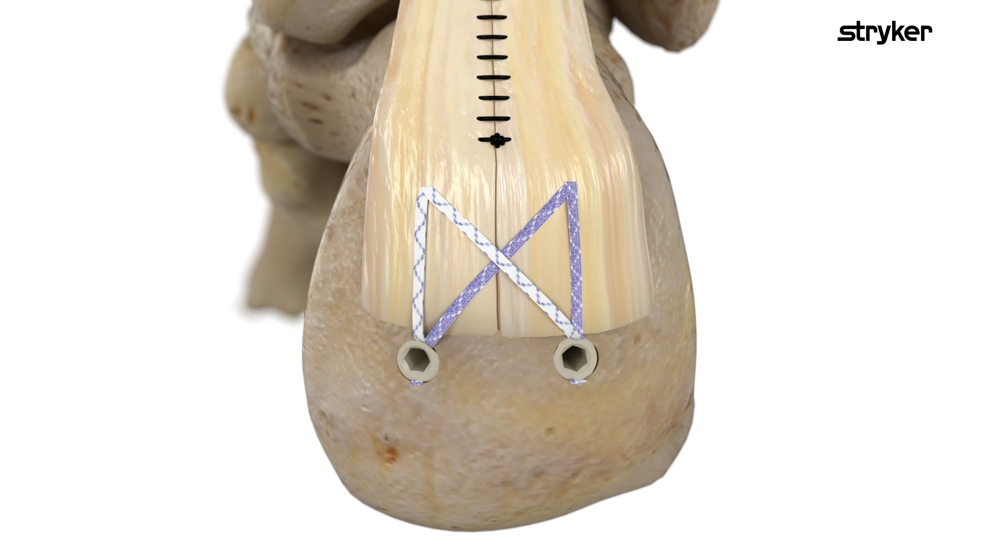 3D medical image of suture of an achilies repair.