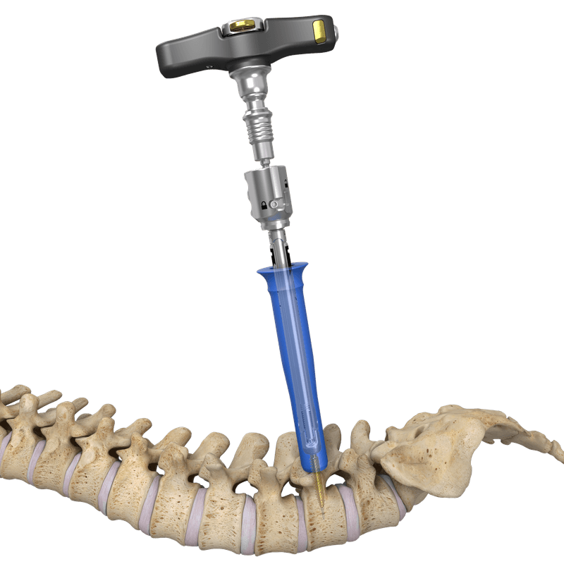 Surgical technique guide image