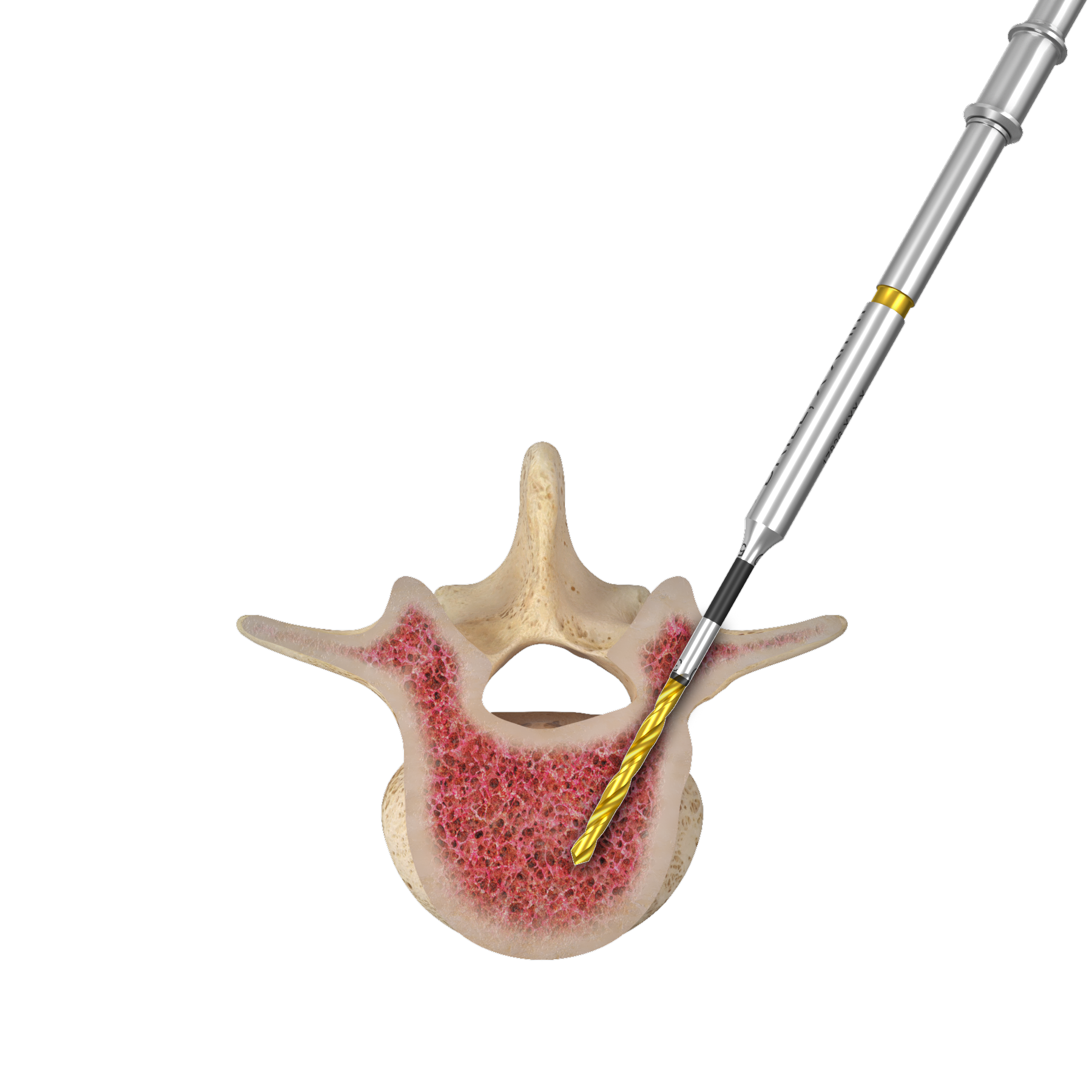 bone cross section with medical device drilling into bone.
